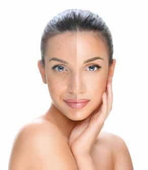Le Laser Enlighten révèle la beauté de votre visage Imaderm Geneve