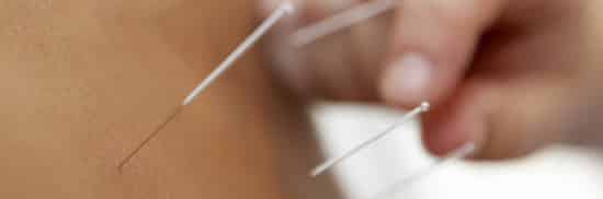 Acupuncture ou acuponcture
