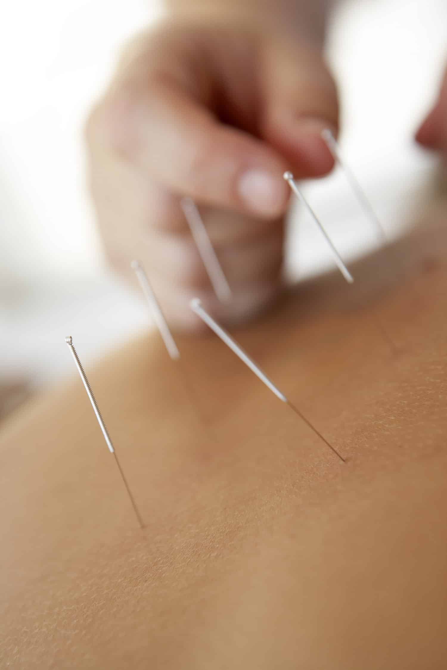 L'acupuncture comme traitement des rides