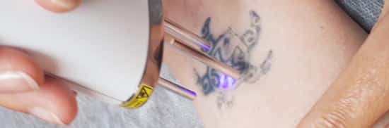 traitement de-tatouage Voeux 2019 Imaderm Genève 