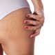 Imaderm vergetures hanches