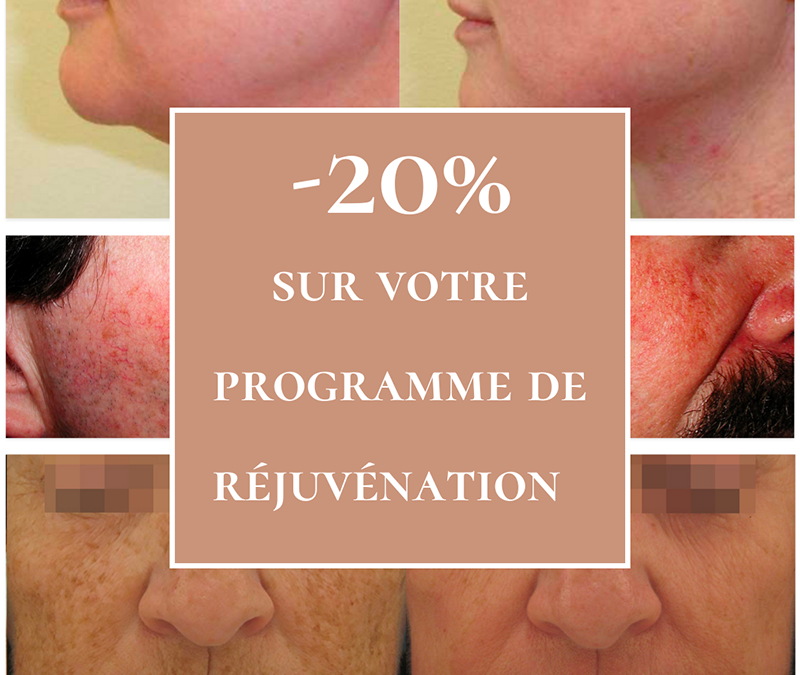 Offre de -20% sur la réjuvénation au laser