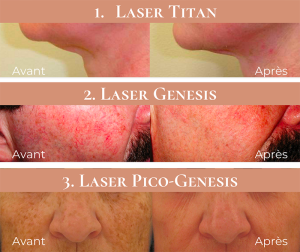 Programme de réjuvénation complet au laser 
