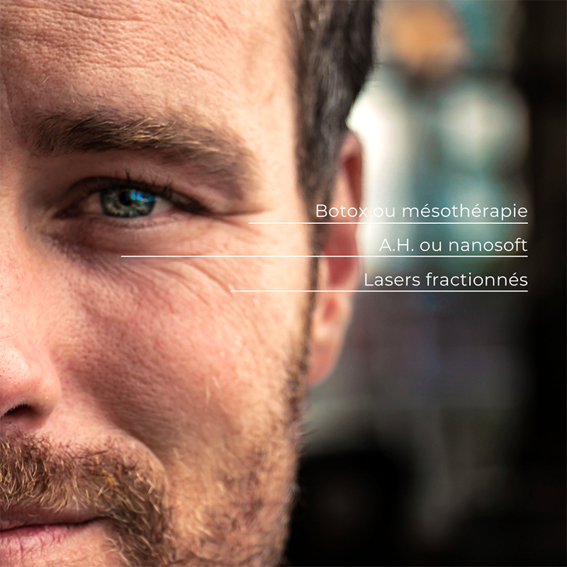 Rides sous les yeux : acide hyaluronique et botox